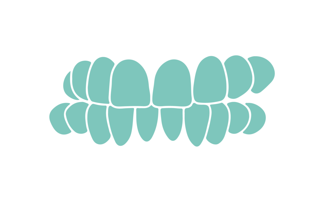 Crossbite Treatment With FinSmile