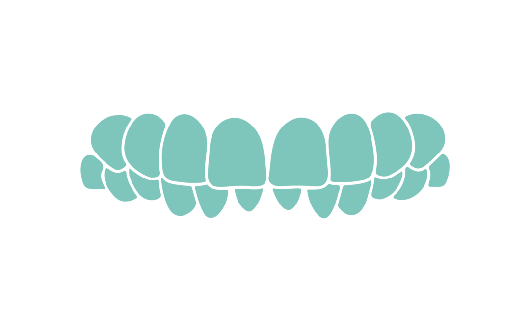 Si trajtohet kafshimi i thellë (DEEPBITE)?