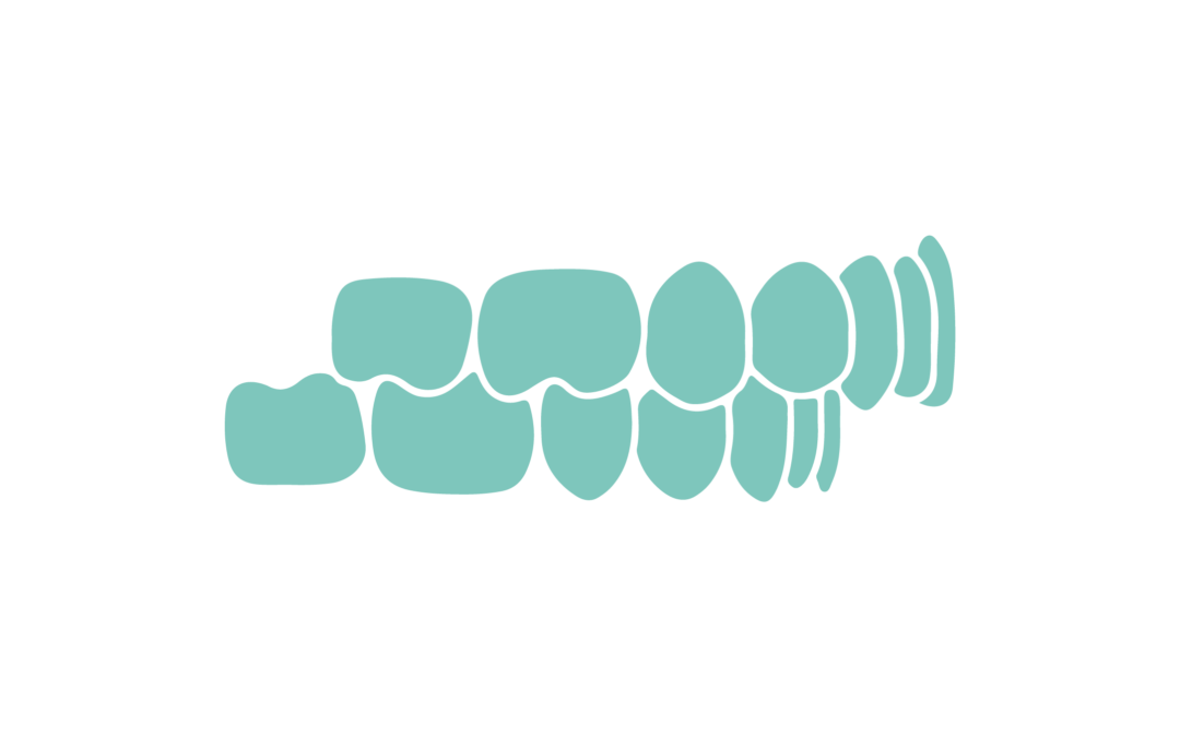 How is OVERBITE treated?