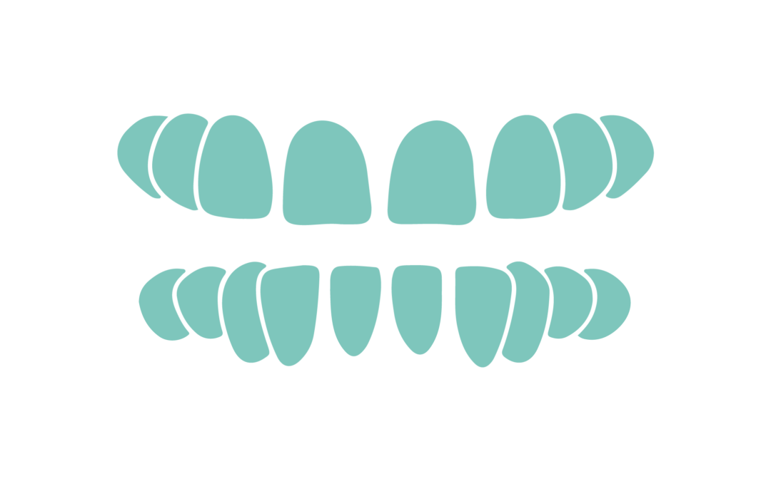 How is treated the gapping between teeth (SPACING)?